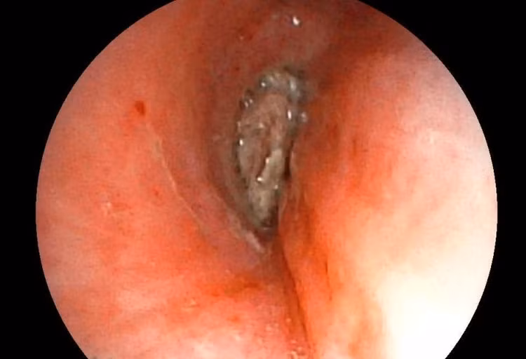 Hình ảnh dị vật góc cạnh khoảng 1cm là hạt kha tử hình bầu dục, gây bít tắc trong lòng phế quản. Ảnh BV