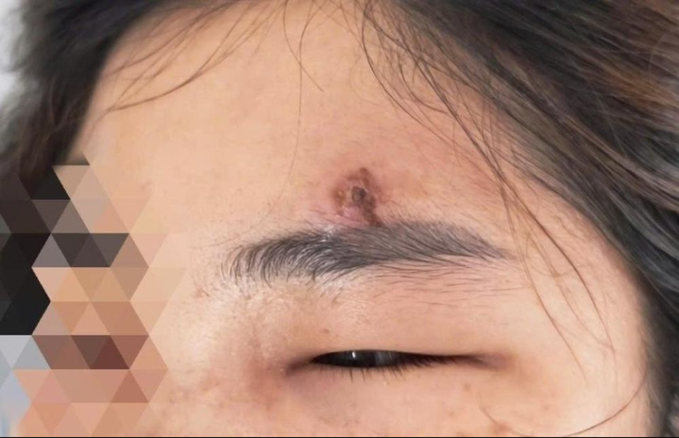 Các bác sĩ chẩn đoán chị L. bị viêm mô bào dưới da vùng mặt. Ảnh: BVCC.