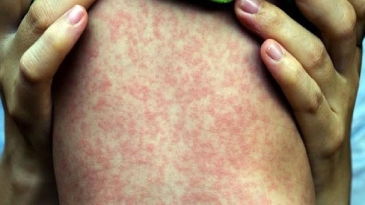 Cách phòng ngừa hiệu quả nhất là tiêm vắc-xin sởi, và điều trị chủ yếu là chăm sóc triệu chứng (hạ sốt, giảm ho, bổ sung nước, dinh dưỡng). Ảnh minh họa/Internet