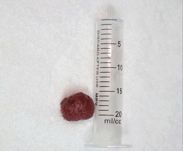 Hình khối polyp sau khi cắt bỏ - Ảnh SKĐS