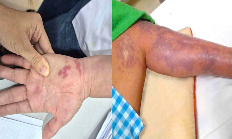 Tổn thương hoại tử, phỏng nước lan rộng ở bàn tay và cánh tay người đàn ông sau khi bị vây cá đâm. Ảnh congly.vn