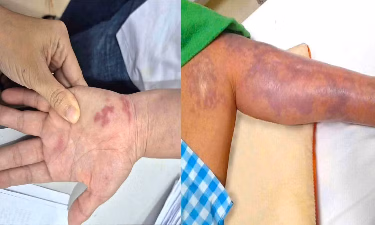 Tổn thương hoại tử, phỏng nước lan rộng ở bàn tay và cánh tay người đàn ông sau khi bị vây cá đâm. Ảnh congly.vn