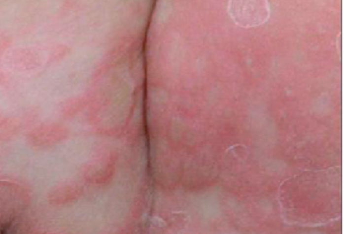 Ban đào hồng là một trong những dấu hiệu của bệnh giang mai bẩm sinh. Ảnh minh họa/NLĐ