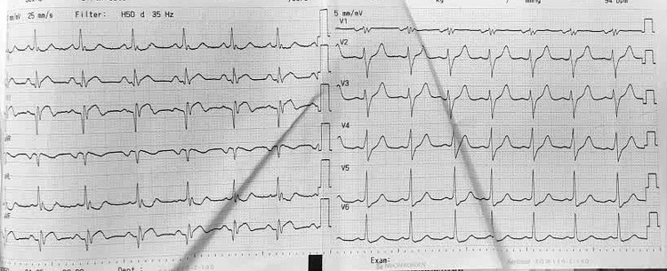 Nhịp tim bất thường trên điện tâm đồ của bệnh nhân Q. sau phẫu thuật. Ảnh BV
