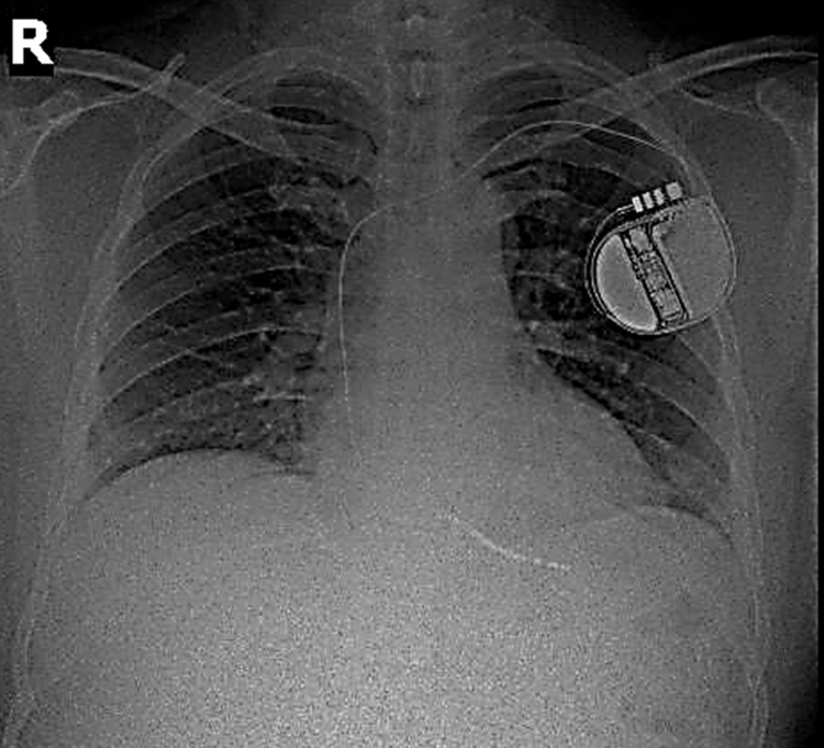 Hình ảnh máy phá rung tim trên phim chụp Xquang. Ảnh BV