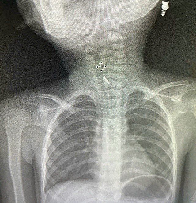 Hình ảnh chụp X-Quang xác định dị vật mắc tại thực quản. Ảnh BV