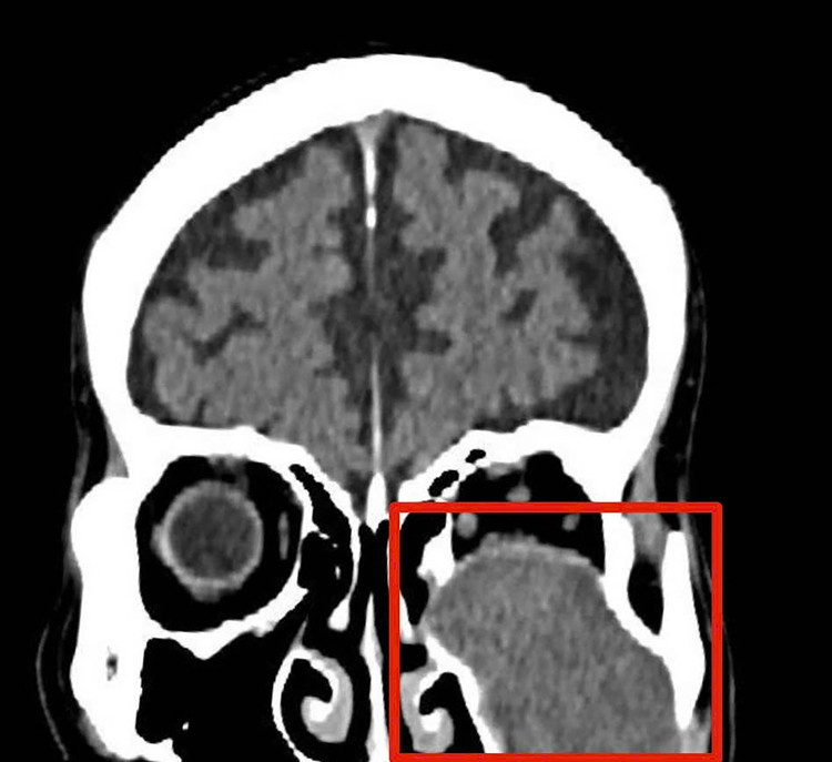 Hình ảnh chụp phim cho thấy khối u ăn mòn tiêu xương sàn ổ mắt. Ảnh nguồn tienphong.vn