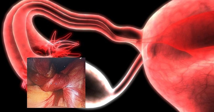 U nang buồng trứng xoắn là căn bệnh nguy hiểm mà chị em không thể chủ quan. Ảnh minh hoạ/Internet