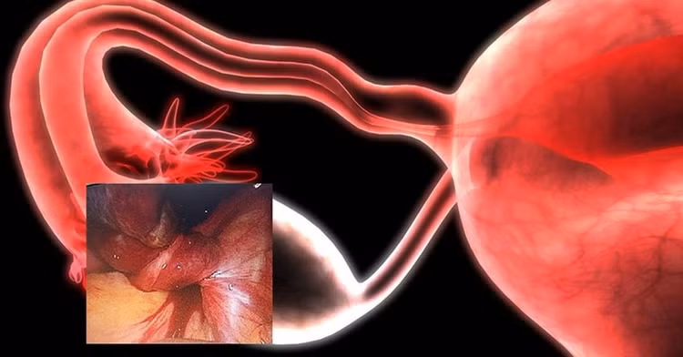 U nang buồng trứng xoắn là căn bệnh nguy hiểm mà chị em không thể chủ quan. Ảnh minh hoạ/Internet