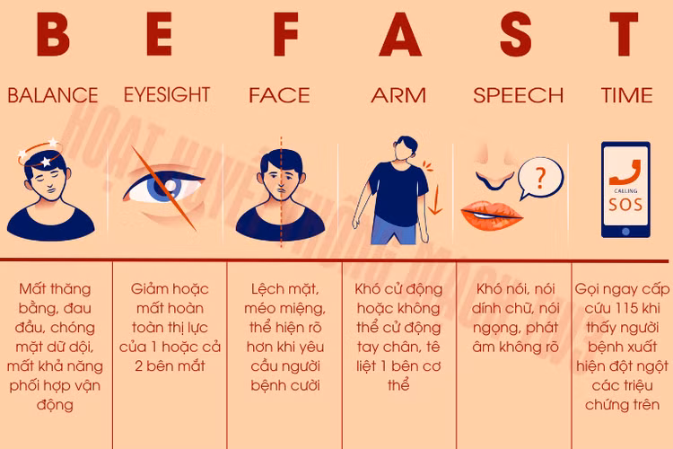 Dấu hiệu nhận biết nhanh đột quỵ theo quy tắc BEFAST. Ảnh minh hoạ/Nguồn Internet