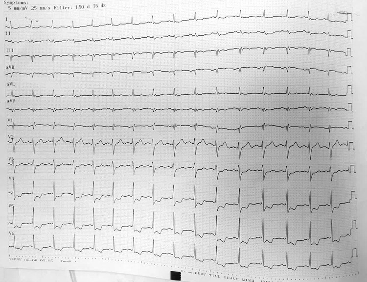 Điện tim bệnh nhân Q. trước mổ bình thường. Ảnh BV