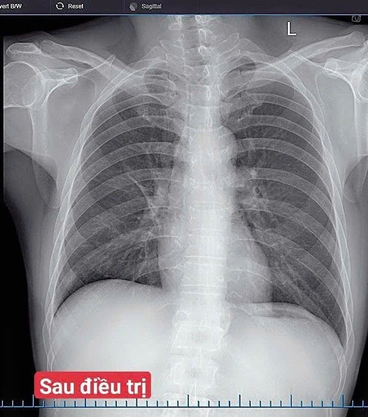 Hình ảnh sau điều trị của người bệnh. Ảnh BV