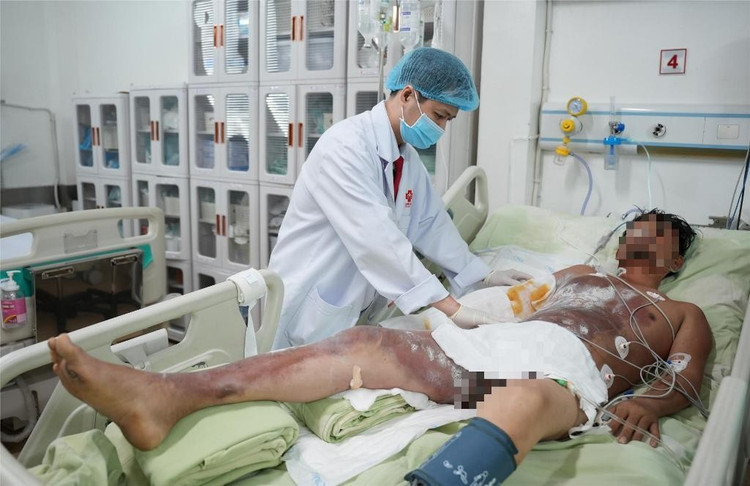 Bệnh nhân C.P. bị bỏng nặng vùng ngực, bụng, tay và chân bên phải, kèm theo yếu tay chân bên phải và chèn ép khoang tay phải...Ảnh BV