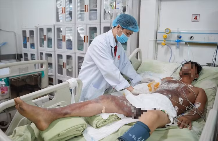 Bệnh nhân C.P. bị bỏng nặng vùng ngực, bụng, tay và chân bên phải, kèm theo yếu tay chân bên phải và chèn ép khoang tay phải...Ảnh BV