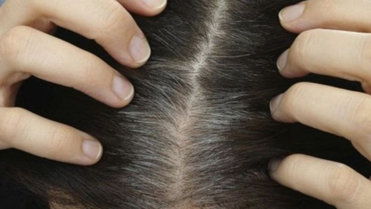 Hạn chế stress, căng thẳng để không bị tóc bạc. Ảnh minh họa/Internet