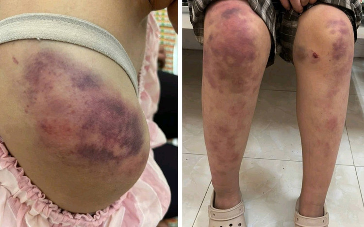 Những vết bầm tím trên cơ thể cháu P.A. do bị đánh/Ảnh PNVN