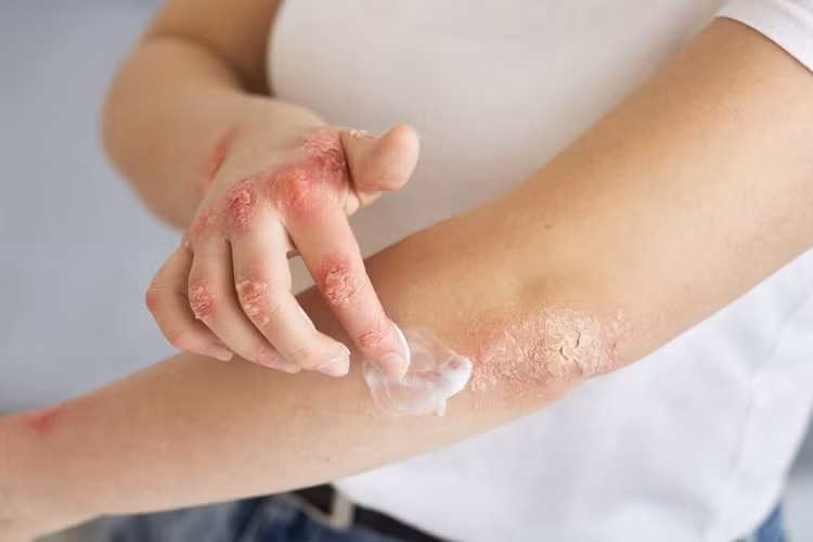 Vào mùa đông cơ thể dễ thiếu vitamin D - chất tham gia điều hòa miễn dịch và hỗ trợ kiểm soát bệnh vảy nến. Ảnh minh họa/Internet