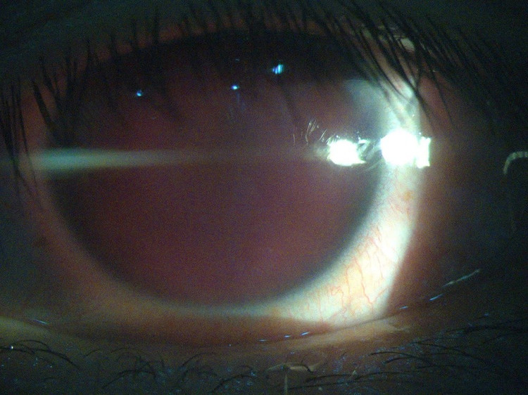 Mắt bệnh nhân bị xuất huyết tiền phòng toàn bộ. (Ảnh: Bệnh viện Mắt Sài Gòn Đà Lạt)