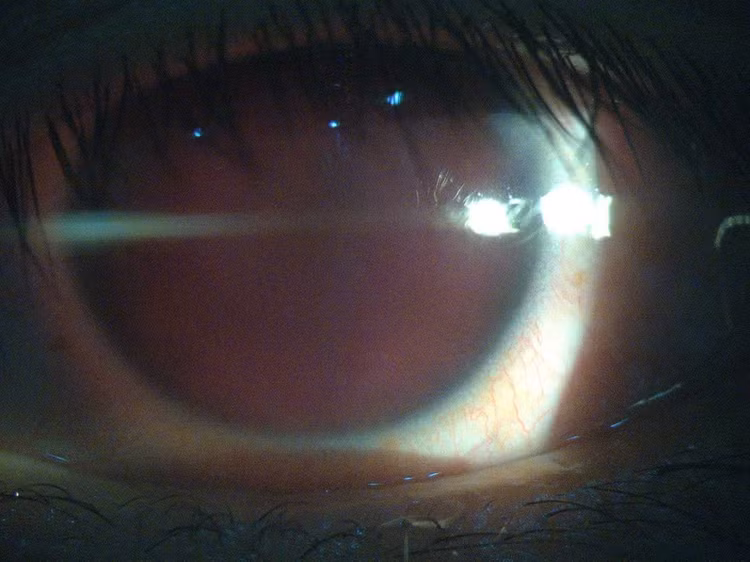 Mắt bệnh nhân bị xuất huyết tiền phòng toàn bộ. (Ảnh: Bệnh viện Mắt Sài Gòn Đà Lạt)