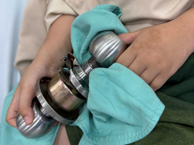 Bé trai đến viện với ngón tay cái bên trái dính chặt vào ổ khóa/ Ảnh Bệnh viện Chấn thương Chỉnh hình TP HCM