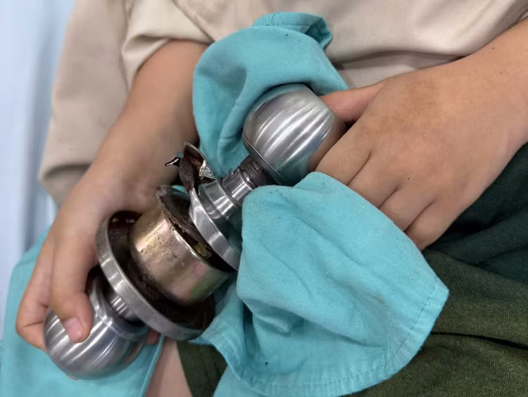 Bé trai đến viện với ngón tay cái bên trái dính chặt vào ổ khóa/ Ảnh Bệnh viện Chấn thương Chỉnh hình TP HCM