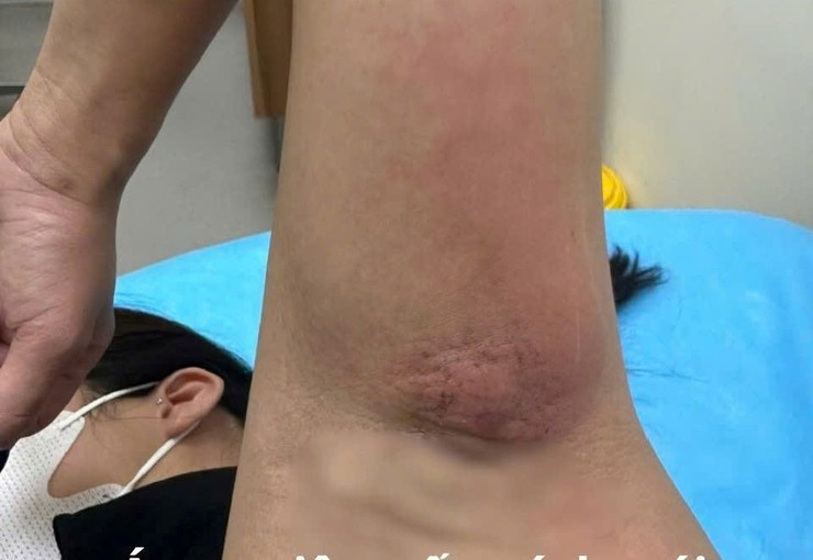 Bệnh nhân bị áp xe viêm tấy nách trái sau khi tự mua cao đắp/Ảnh SYT Hà Nội