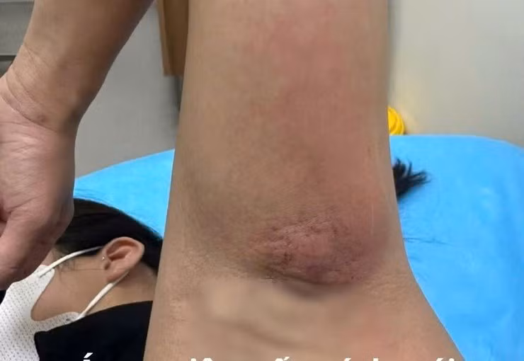 Bệnh nhân bị áp xe viêm tấy nách trái sau khi tự mua cao đắp/Ảnh SYT Hà Nội
