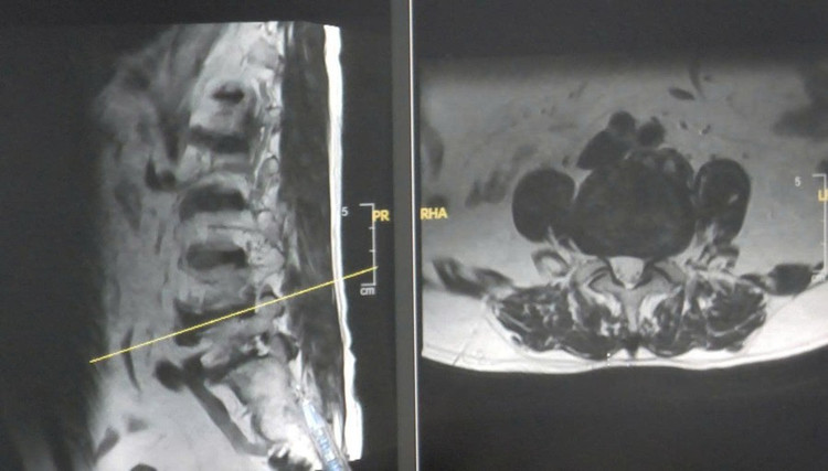 Hình ảnh MRI thoát vị đĩa đệm của bệnh nhân. (Ảnh: BVCC)