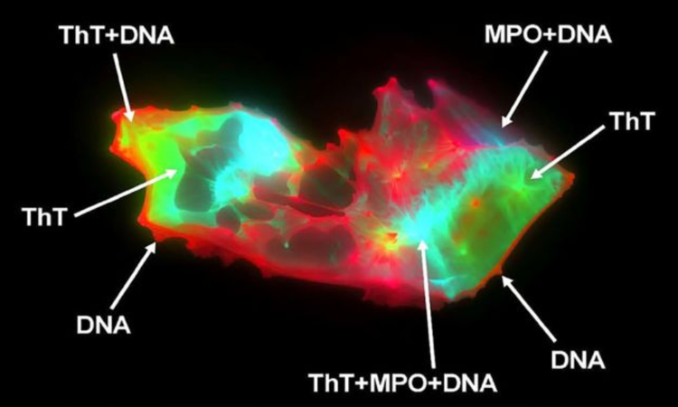 Hình ảnh của vi huyết khối được tìm thấy trong máu của một người mắc COVID kéo dài dưới kính hiển vi. Các vùng màu xanh lá cây là vi huyết khối, trong khi các phần màu đỏ và xanh lam là các phần tử có nguồn gốc tế bào. Ảnh: Tiến sĩ Chantelle Venter/ScienceAlert