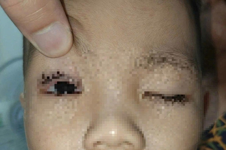 Bé trai 2 tuổi ở Ninh Bình phải nhập viện vì bị pháo hoa bắn trúng mắt. Ảnh: Đại biểu Nhân dân