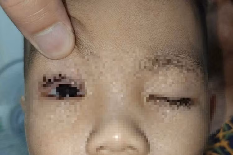 Bé trai 2 tuổi ở Ninh Bình phải nhập viện vì bị pháo hoa bắn trúng mắt. Ảnh: Đại biểu Nhân dân