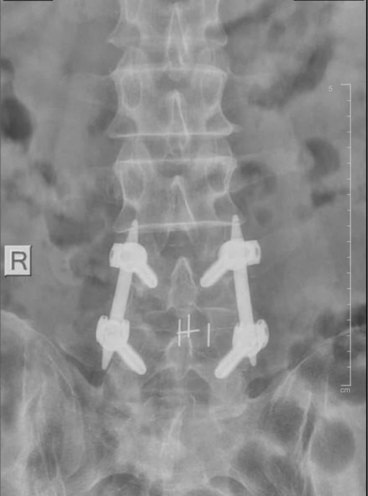 Hình ảnh MRI của bệnh nhân thực hiện bắt vít qua da. Ảnh BV