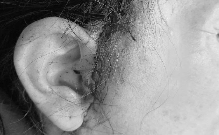 Bệnh nhân nữ L.T.H (64 tuổi) nhập viện trong tình trạng biến chứng nghiêm trọng sau khi thực hiện phẫu thuật căng da mặt/ Ảnh: ĐVCC