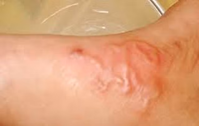 Khi có các triệu chứng nghi ngờ mắc bệnh sán chó, như ngứa ngáy ở nhiều vị trí trên cơ thể, người dân nên đến cơ sở y tế để được khám và tư vấn điều trị. Nhiễm sán chó gây ngứa, nổi mề đay kéo dài.