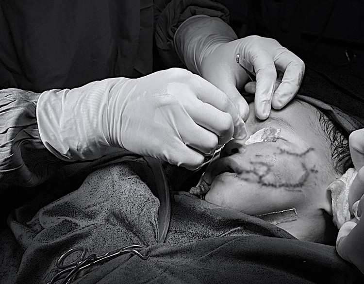 Bé gái bị thương phức tạp vùng mặt do chó cắn - Ảnh: BVCC