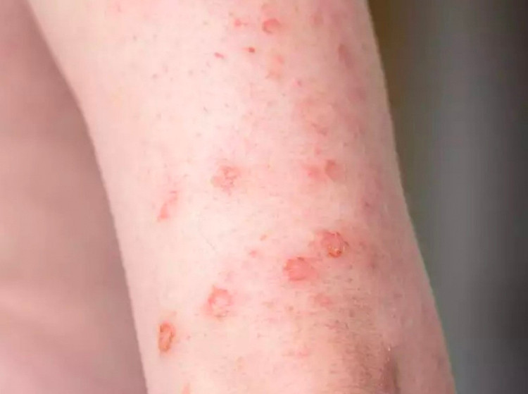 Triệu chứng khi bị giang mai. Ảnh minh họa/Nguồn Internet