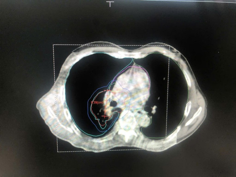 Hình ảnh cận lâm sàng cho thấy khối ung teo nhỏ sau 5 buổi điều trị. Ảnh BV
