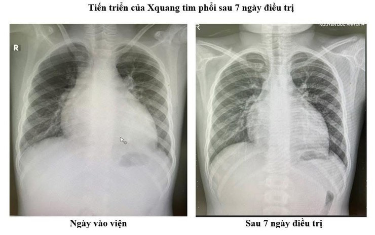 Tiến triển của X-quang tim phổi sau 7 ngày điều trị. Ảnh BV