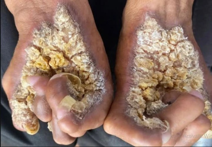 Ông S. phát bệnh từ lúc 2 tuổi. Ảnh NLĐ