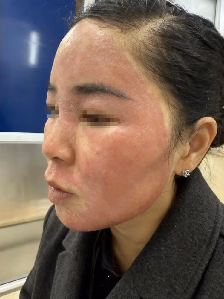 Bệnh nhân tới thăm khám trong tình trạng vùng má và cằm đỏ bừng, sần sùi, từng mảng da bong vảy rõ rệt. Ảnh bác sĩ cung cấp/Nguồn daibieunhandan.vn