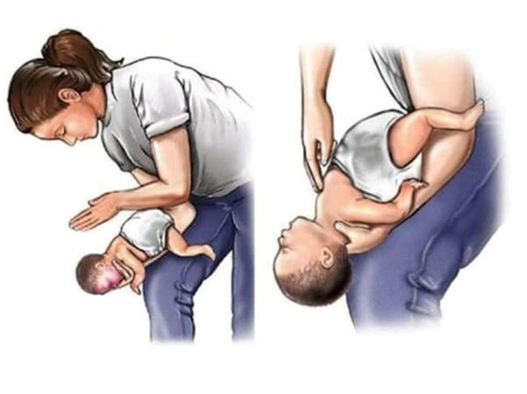 Thủ thuật vỗ lưng ấn ngực bằng cách đặt trẻ nằm sấp. Ảnh minh họa/Internet