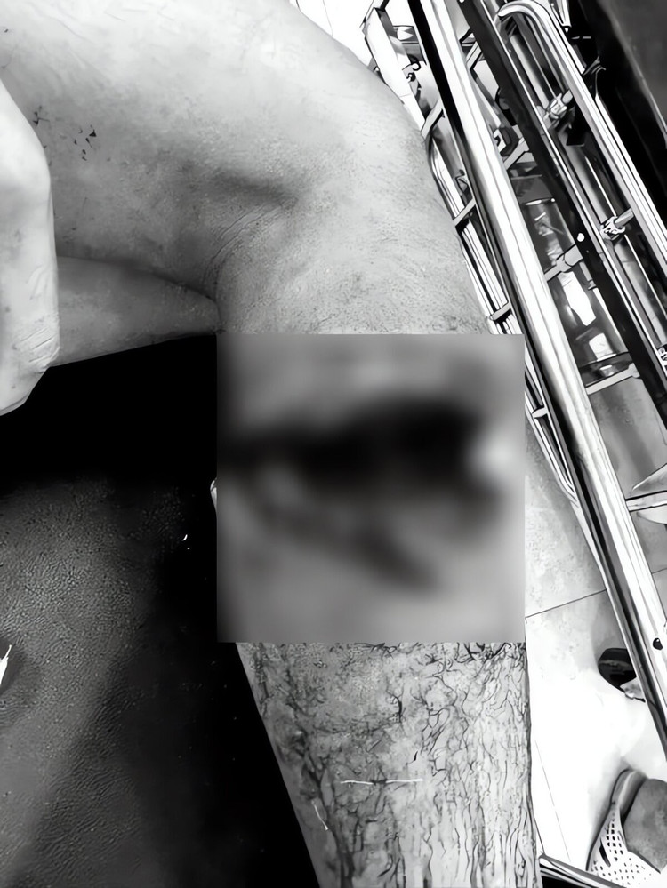 Hình ảnh vết thương của bệnh nhân đưa vào viện cấp cứu. Ảnh BV