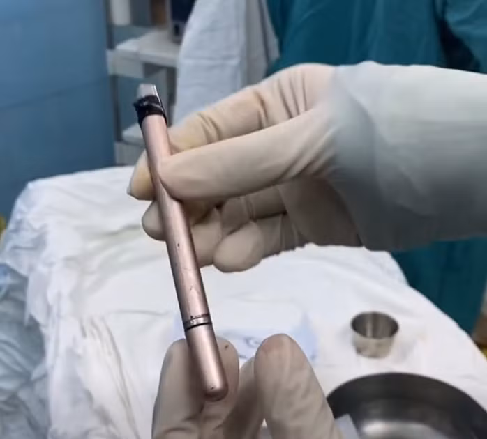 Dị vật là cây bút được bác sĩ lấy ra khỏi bàng quang của bệnh nhân. Ảnh NLĐ