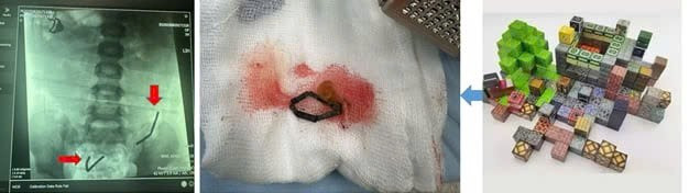 Trẻ chơi lego xong cắn bỏ nắp nhựa và nuốt viên nam châm bên trong. Ảnh: BVCC/Nguồn SKĐS.