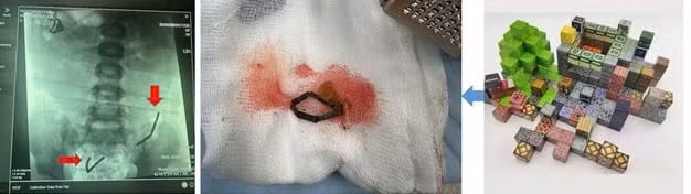 Trẻ chơi lego xong cắn bỏ nắp nhựa và nuốt viên nam châm bên trong. Ảnh: BVCC/Nguồn SKĐS.