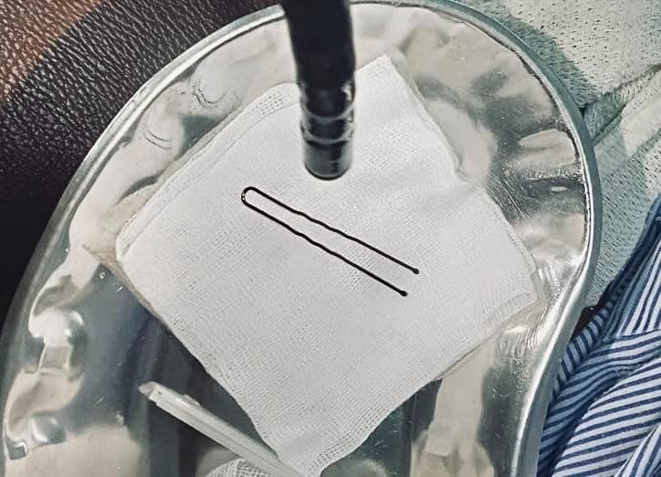 Dị vật là chiếc cặp tóc mai được bác sĩ gắp ra. Ảnh BV