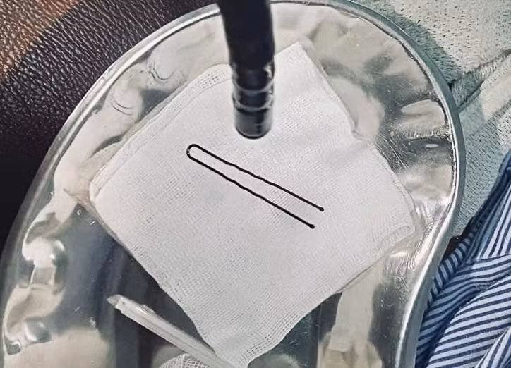 Dị vật là chiếc cặp tóc mai được bác sĩ gắp ra. Ảnh BV