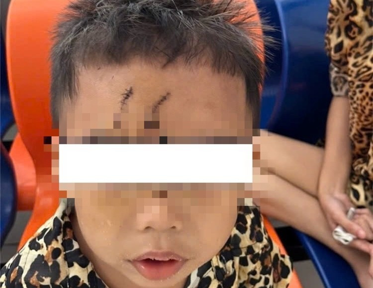 Bé trai 5 tuổi bị chó cắn gây biến dạng khuôn mặt hiện đã lành các vết thương. Ảnh BV