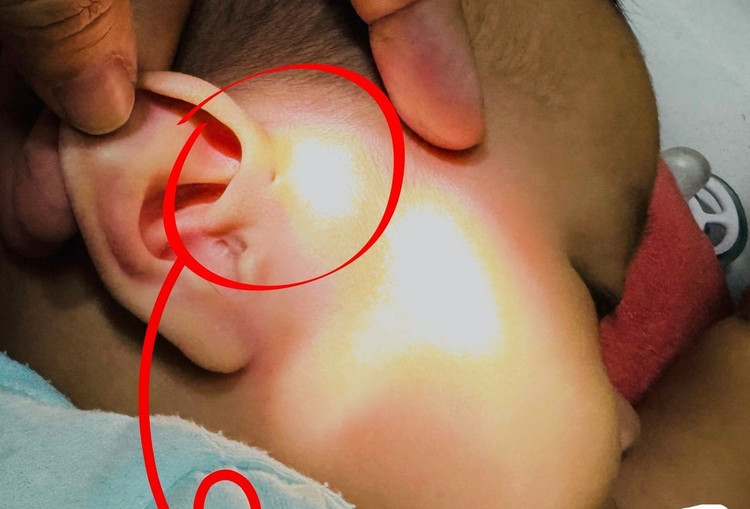 Vị trí lỗ rò luân nhĩ khiến bệnh nhi bị áp xe thái dương/ Ảnh tienphong.vn