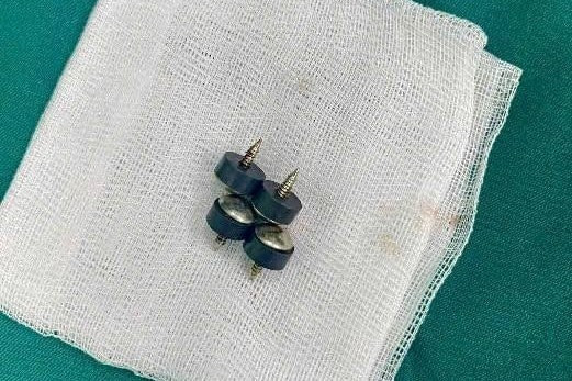 Dị vật được lấy ra khỏi bệnh nhi. Ảnh BV